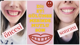 DİŞ ETİ GÜLÜMSEMESİ AMELİYATIMIN SONUCU|GUMMY SMİLE SONUCU|PEMBE ESTETİK