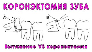 Коронэктомия VS вытяжение нижних зубов мудрости, разбираемся на примере научных статей