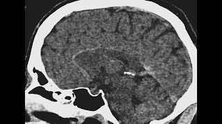 Vessel hyperdensity: not always a thrombosis !!!