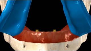 Denture: Fixed, 2 Locator Implants