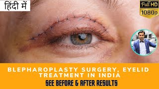 (हिंदी में) Blepharoplasty (Eyelid Surgery) to Remove Eyelid Bags & Eye Sagging in India- TEC