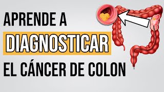 🔴 CÁNCER DE COLON [El + frecuente en España] *Aprende a RECONOCER SÍNTOMAS*