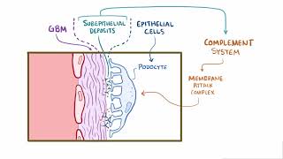 Membranous Glomerulonephritis | Renal Pathology | Osmosis