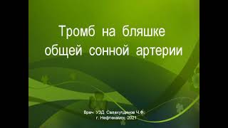 Тромб на бляшке общей сонной артерии