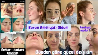 Burun Ameliyatı Sürecim 👃 | Günden Güne Değişim | Part 1 | Hastane - Doktor Seçimim