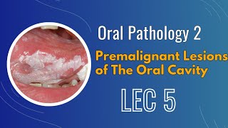 Oral Pathology 2 ; Lec 5 ; Premalignant Lesions of The Oral Cavity