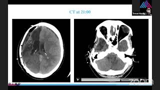 Malignant Brain Edema After Cranioplasty with Spyridoula Tsetsou, MD