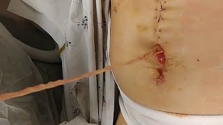 What's in my Cyst?  Wound Packing!  Infections and Drains