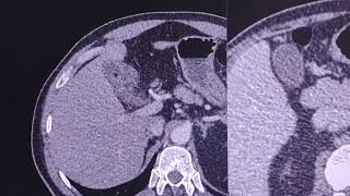 Gallbladder minimal CT findings