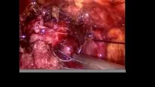 Single incision radical prostatectomy (LESS)