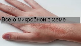 Все о микробной экземе