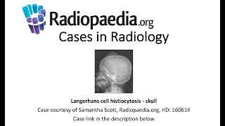 Langerhans cell histiocytosis - skull (Radiopaedia.org) Cases in Radiology