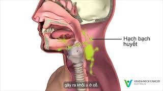 Vietnamese - What is Oral or Mouth Cancer? Signs & Symptoms. Head and Neck Cancer