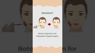 Botox Masseter Hypertrophy Treatment, Botulinum Toxin Injection-@TheEstheticClinics, Mumbai, India​