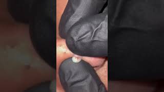 Pimple Pop Compilation #wow #oddlysatisfying #sick #blackhead #pimplepopper #satisfying #acne #cyst