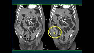 CT Evaluation of GI Bleeding - Part 3