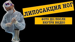 МОЯ ЛИПОСАКЦИЯ/ СКОЛЬКО СТОИТ ЛИПОСАКЦИЯ?