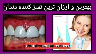 یکی از بهترین حساب دندان که شما میتوانید به راحتی ضامن سلامتی دندان های تان شوید dental calculusre