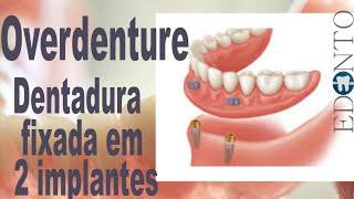 Overdenture, prótese total fixa por dois implantes