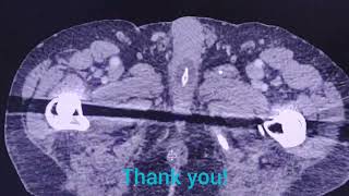 Malposition of Folley catheter - the importance to check !!! - CT findings