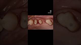 VERTCIAL PREPARATION power of vertical preparation #dentist #cappingsystem #endodontics #satisfying