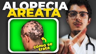 ALOPECIA AREATA | NUEVOS TRATAMIENTOS, síntomas y causa