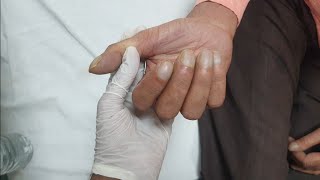 Finger Clubbing in Lung Carcinoma Patient