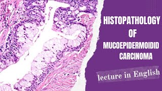 Histopathology of Mucoepidermoid Carcinoma// English Lecture