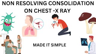 non resolving consolidation |  six main causes and their explanation