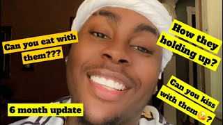 Shiny Smile Veneers 6 month update and Q&A