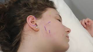 TMJ/Jaw Pain - Combining Piezowave and Dry Needling treatments