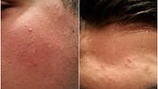 PELLE viso DA FAVOLA scrub profondo risolve"pori dilatati-punti neri-cicatrici di acne-rughe"