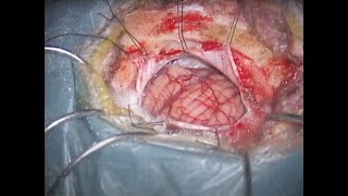 Microvascular decompression for trigeminal neuralgia caused by trigeminocerebellar artery