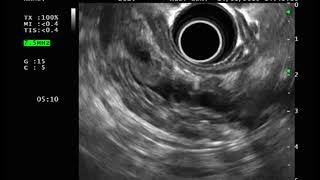 Pancreas chronic calcific pancreatitis 1