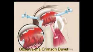 Arthroscopic Rotator Cuff Reconstruction using GraftJacket Allograft