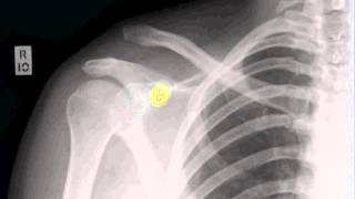 Interpreting X-Rays of the Shoulder Joint