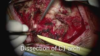 Vertebral artery mobilization for C1–2 reduction and fixation