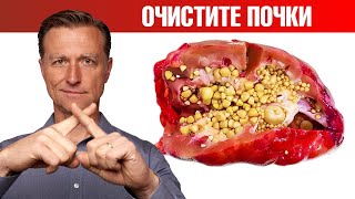 Очищение почек от оксалатов. Профилактика камней в почках ✅