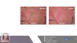 The benefits of the Fraxel Dual resurfacing device  - Dr  Mary Lupo