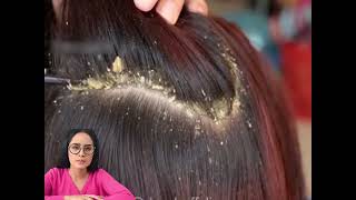 Dandruff and hair: how to eliminate dandruff and scales