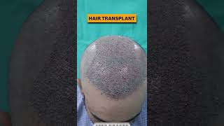 Amazing FUE Hair Transplant transformation - Get your hair and confidence back! #hairtransplant