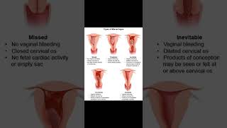 Types of Miscarriage