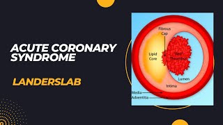 Acute Coronary Syndrome