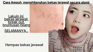 CARA MENGHILANGKAN BEKAS JERAWAT DENGAN CEPAT || INDAH NIRMALA