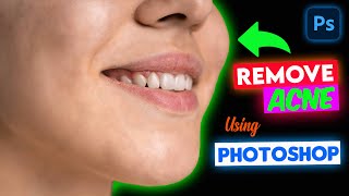 Acne? Not Anymore! Photoshop Hacks for Clear Skin