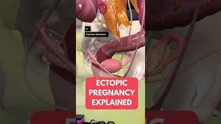 Did you know this about ectopic pregnancies? *Mind Blown*