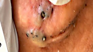 Blackhead Removal Videos 2021- Ear Blackheads Removal | Best pimple popper videos 2021