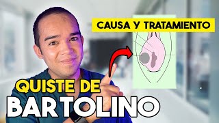 QUISTE de BARTOLINO, ¿es una ETS? - CAUSA y TRATAMIENTO