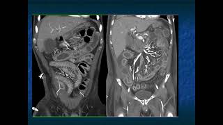 Abdominal Pain in the ER: GI Pathology - Part 2