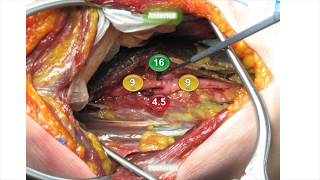 MIS lateral ACR for spinal deformity correction: technique and complication avoidance